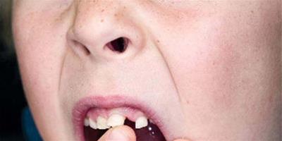 夢到牙齒脫落是否和個人的健康有關？