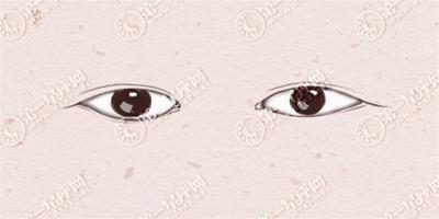 單眼皮分幾種眼形 有什么特征
