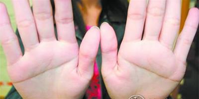 特殊的掌紋：雙手斷掌的幾率有多大
