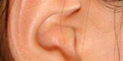 右耳廓有痣好嗎？ 詳解耳朵有痣的含義